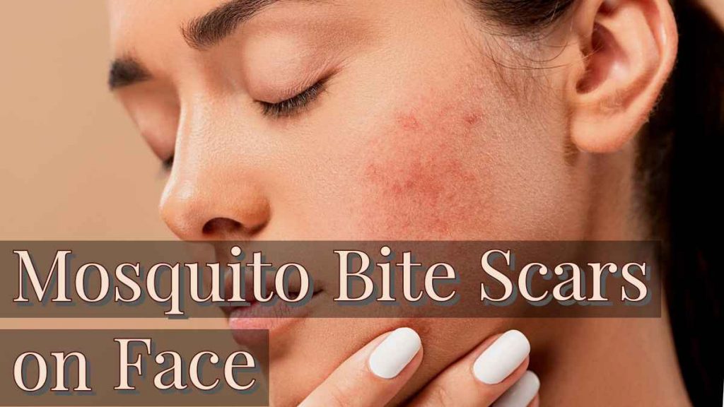 mosquito-bite-scars-on-face-how-to-treat-mosquito-bite-marks-on-the